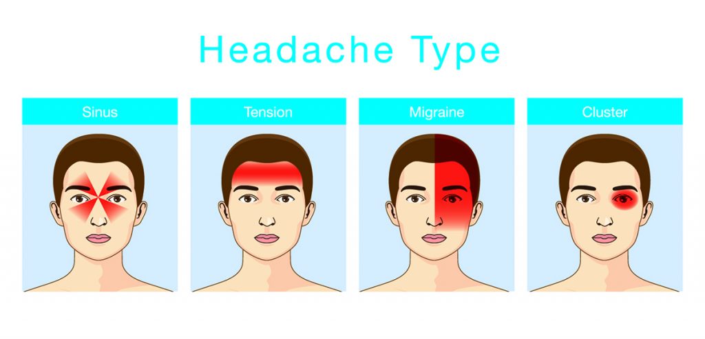 The four main types of headaches and where the pain resonates.